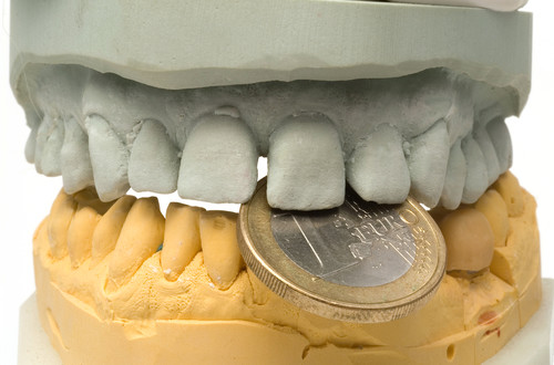 Implants dentaires : zoom sur les options de remboursement